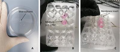 Optimizing culturing conditions in patient derived 3D primary slice cultures of head and neck cancer